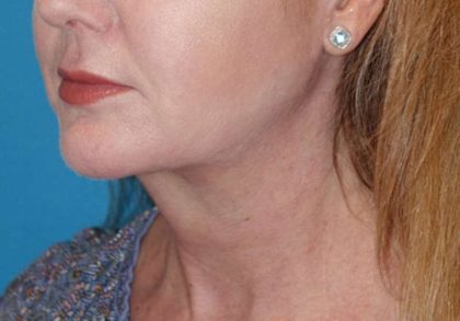 Neck Lift Before & After Patient #1018