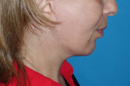 Deep Plane Lower Face & Neck Lift Before & After Patient #1041