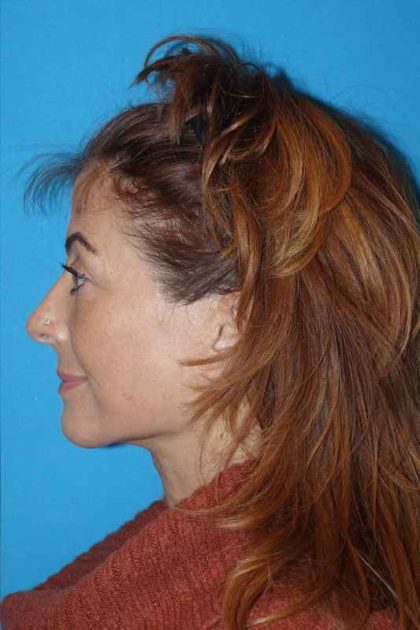 Deep Plane Lower Face & Neck Lift Before & After Patient #1052