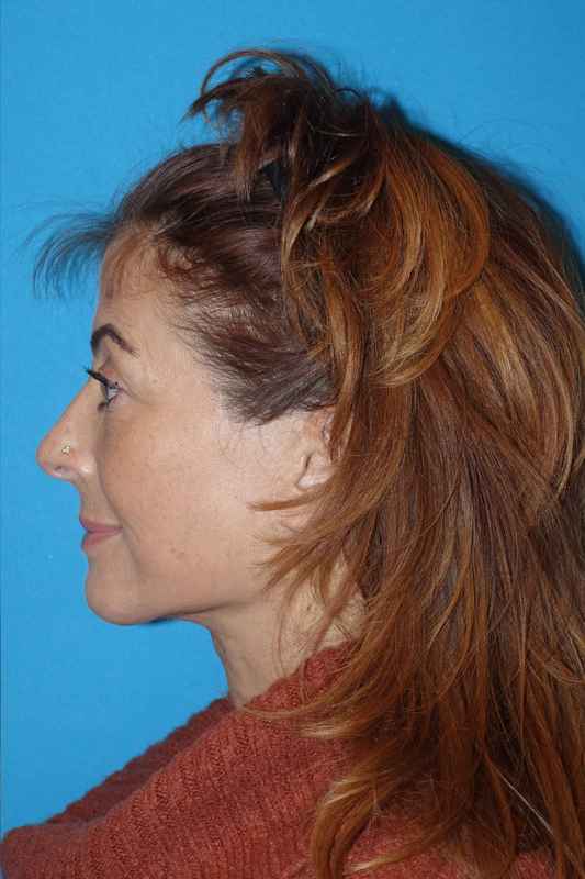 Deep Plane Lower Face & Neck Lift Before & After Patient #1052