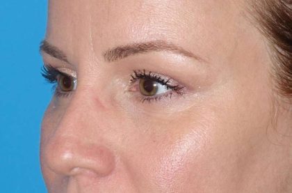 Eyelid Lift- Upper Before & After Patient #765