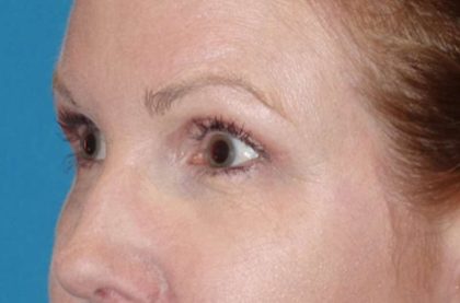 Eyelid Lift- Upper Before & After Patient #776