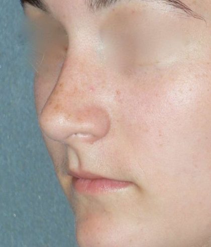 Rhinoplasty Before & After Patient #787
