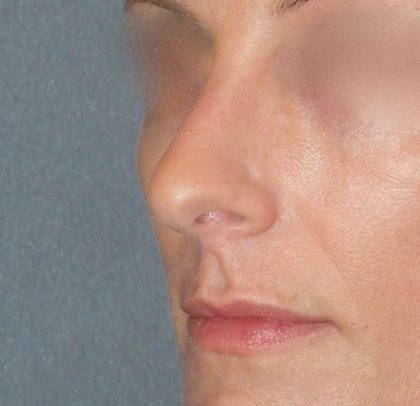 Rhinoplasty Before & After Patient #798