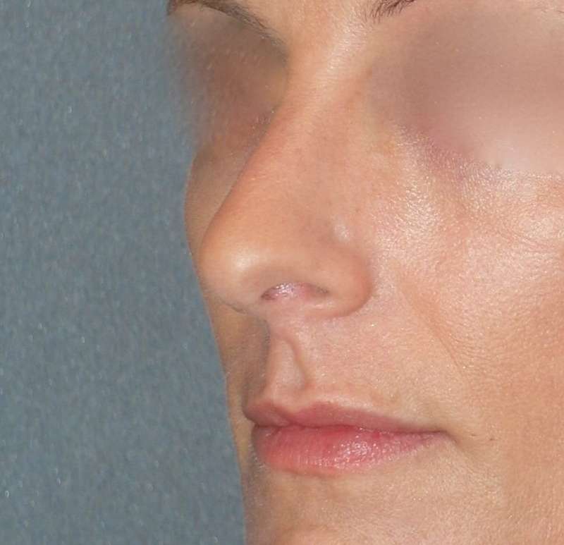 Rhinoplasty Before & After Patient #798