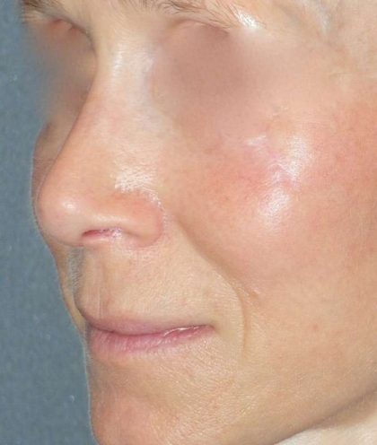 Rhinoplasty Before & After Patient #809