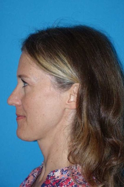 Rhinoplasty Before & After Patient #834