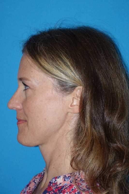 Rhinoplasty Before & After Patient #834