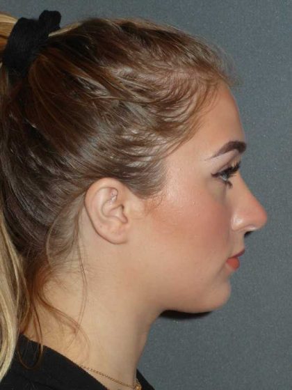 Rhinoplasty Before & After Patient #856