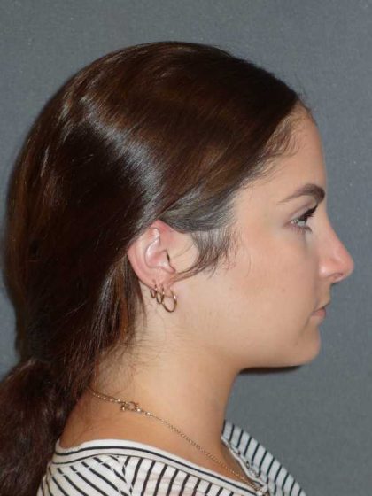 Rhinoplasty Before & After Patient #867