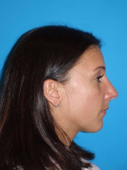 Rhinoplasty Before & After Patient #878