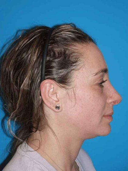 Rhinoplasty Before & After Patient #898