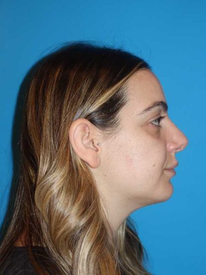 Rhinoplasty Before & After Patient #909