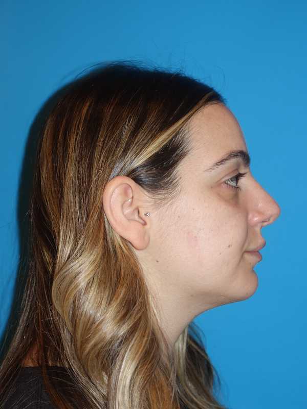 Rhinoplasty Before & After Patient #909