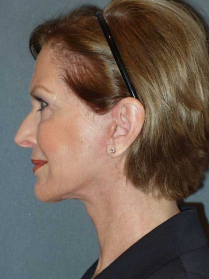 Deep Plane Lower Face & Neck Lift Before & After Patient #920