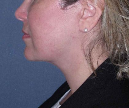Deep Plane Lower Face & Neck Lift Before & After Patient #947
