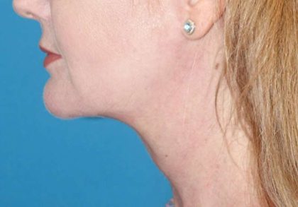 Neck Lift Before & After Patient #1018