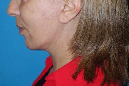 Deep Plane Lower Face & Neck Lift Before & After Patient #1041