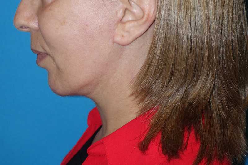 Deep Plane Lower Face & Neck Lift Before & After Patient #1041