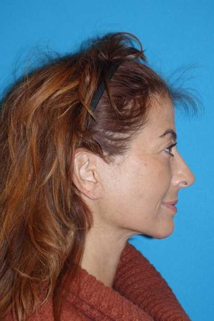 Deep Plane Lower Face & Neck Lift Before & After Patient #1052