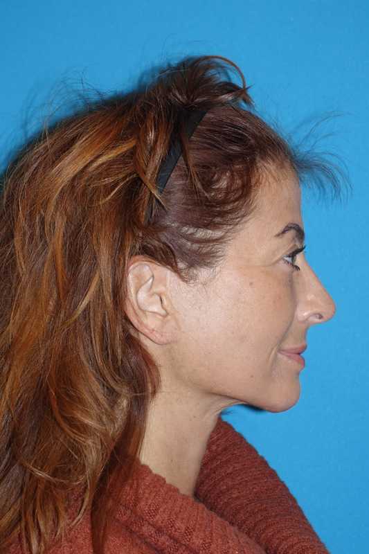 Deep Plane Lower Face & Neck Lift Before & After Patient #1052