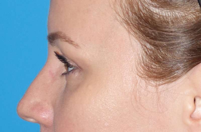 Eyelid Lift- Lower Before & After Patient #731