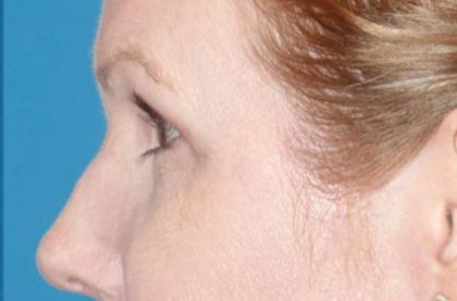 Eyelid Lift- Lower Before & After Patient #742