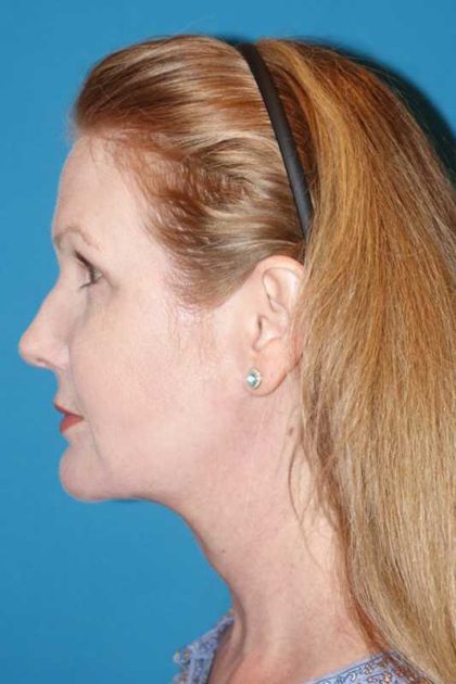 Morpheus8 Before & After Patient #693