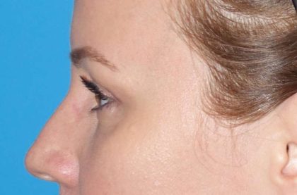 Eyelid Lift- Upper Before & After Patient #765