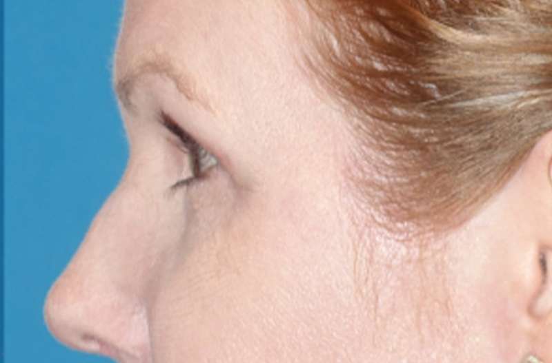 Eyelid Lift- Upper Before & After Patient #776
