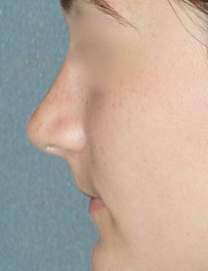Rhinoplasty Before & After Patient #787