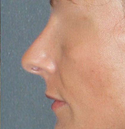Rhinoplasty Before & After Patient #798