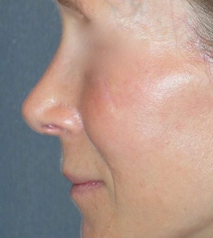 Rhinoplasty Before & After Patient #809