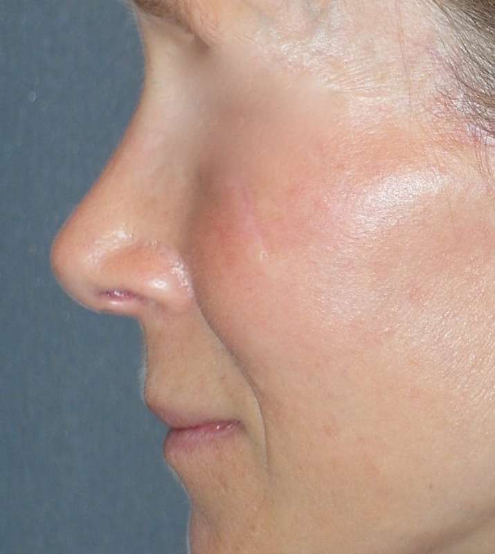 Rhinoplasty Before & After Patient #809