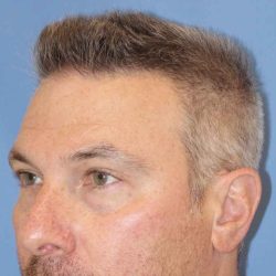 Juvéderm - Tear Troughs Before & After Patient #651