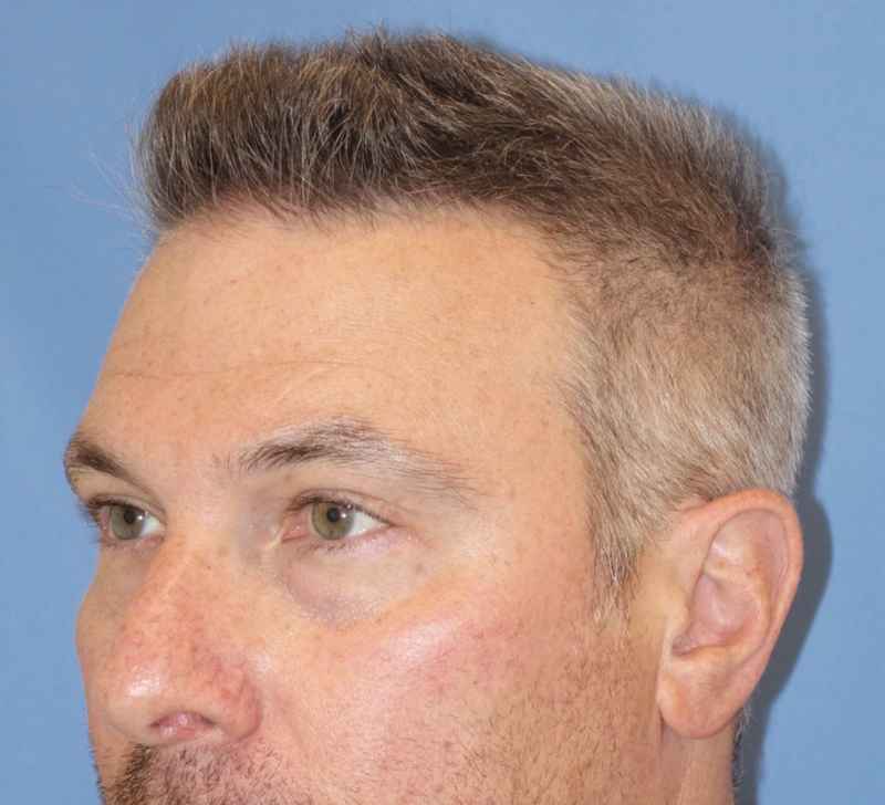 Juv&eacute;derm - Tear Troughs Before & After Patient #651