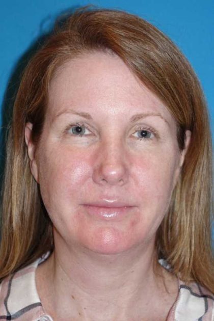FaceTite Before & After Patient #704