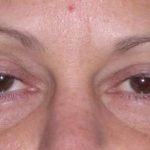 Fat Transfer Before & After Patient #715