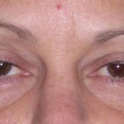Fat Transfer Before & After Patient #715