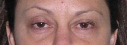 Fat Transfer Before & After Patient #715