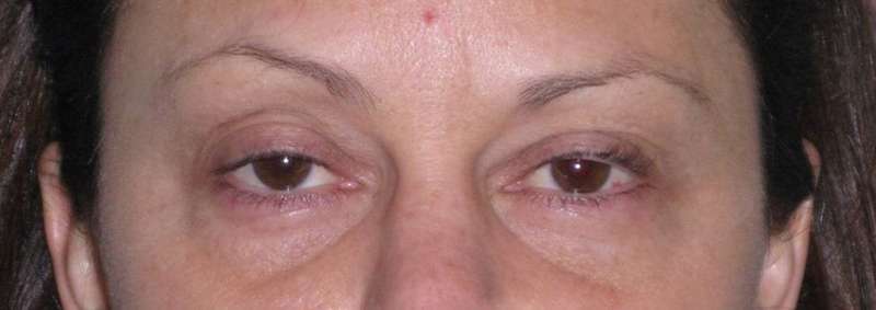 Fat Transfer Before & After Patient #715