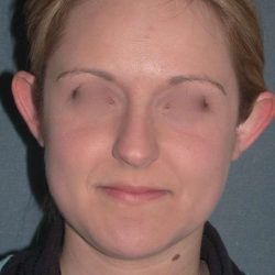 Otoplasty Before & After Patient #720