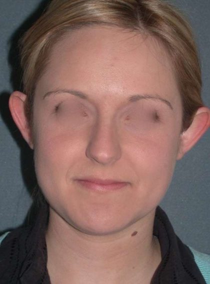 Otoplasty Before & After Patient #720