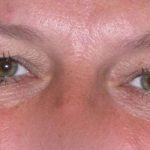 Eyelid Lift- Upper Before & After Patient #747