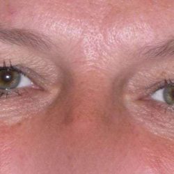 Eyelid Lift- Upper Before & After Patient #747