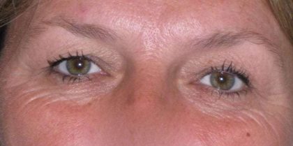Eyelid Lift- Upper Before & After Patient #747