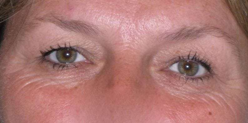 Eyelid Lift- Upper Before & After Patient #747