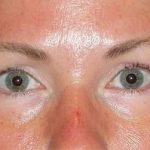 Juv&eacute;derm - Tear Troughs Before & After Patient #648