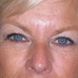 Eyelid Lift- Upper Before & After Patient #754