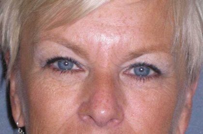 Eyelid Lift- Upper Before & After Patient #754